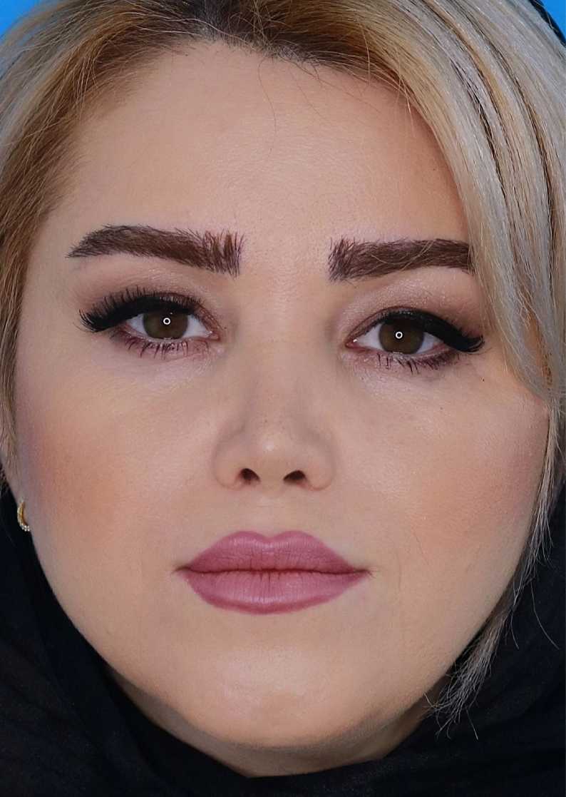 2 ماه بعد از جراحی بینی نچرال آرت - 10