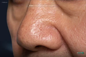همه چیز درباره عمل بینی گوشتی - دکتر بحری