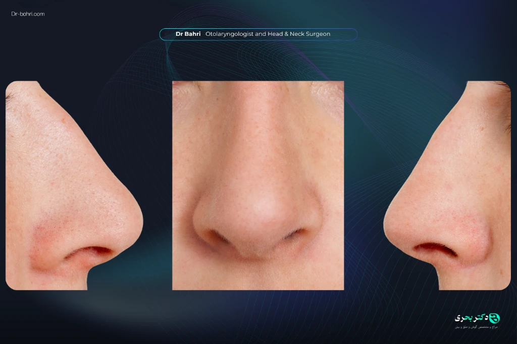 Nasal Alae - dr bahri 3